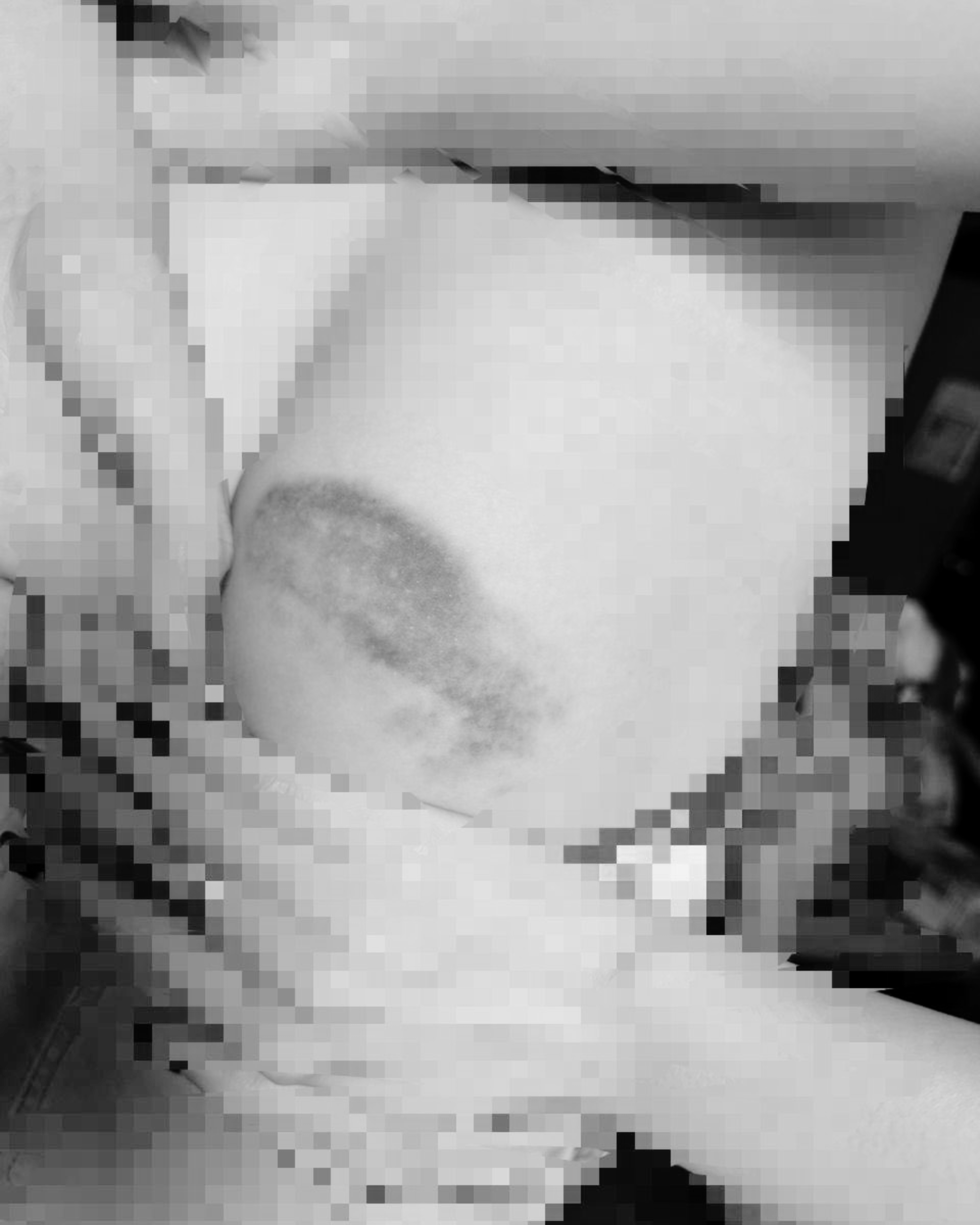 Bruises Pic 1