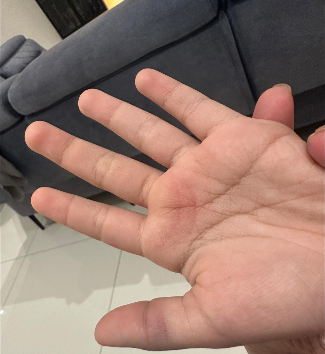 Child's swollen hand after getting caned