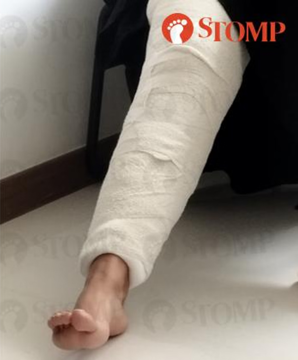 Nurafiza's dislocated right knee